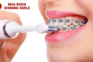 Niềng Răng Có Nên Dùng Bàn Chải Điện Không? Tìm Hiểu Lợi Ích Và Hướng Dẫn Sử Dụng