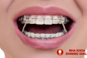 Niềng Răng Nanh: Giải Pháp Hiệu Quả Cho Răng Mọc Lệch Và Ngầm