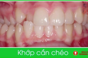 Tầm Quan Trọng của Việc Điều Trị Niềng Răng Khớp Cắn Chéo Sớm