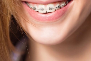 18 Tuổi Niềng Răng Được Không? Lời Khuyên Từ Chuyên Gia