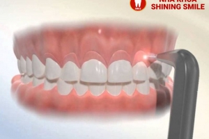 Vì Sao Niềng Răng Cần Cắt Lợi? Những Điều Bạn Cần Biết