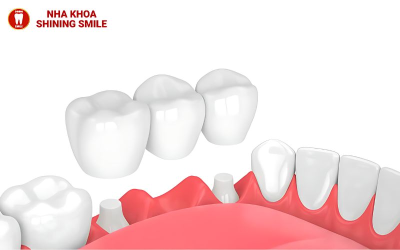 Giải Mã Hiện Tượng Niềng Răng Bị Hở Chân Răng