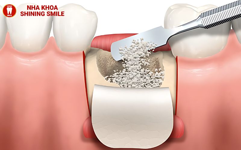 Niềng Răng Cho Trẻ Chưa Thay Hết Răng: Thời Điểm Và Khuyến Nghị