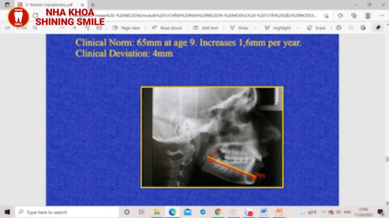 Phát Triển Nụ Cười Rạng Rỡ: Có Nên Niềng Răng Sớm Cho Trẻ Hay Không?