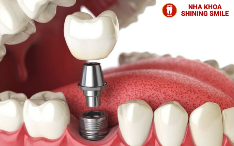 Niềng Răng Có Được Bảo Hiểm Không? Thông Tin Cần Biết Trước Khi Điều Trị