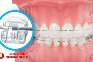 Niềng Răng Mắc Cài Sứ Trong Bao Lâu? Bí Ẩn Đằng Sau Thời Gian Đặc Biệt