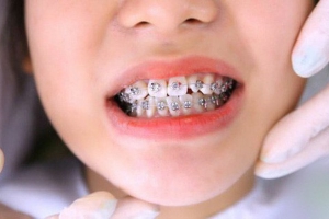Niềng Răng Cho Trẻ 9 Tuổi: Bí Quyết Tạo Nụ Cười Rạng Rỡ