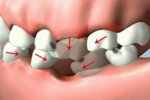 Làm Cầu Răng: Quy Trình, Chi Phí Và Những Điều Bạn Cần Biết