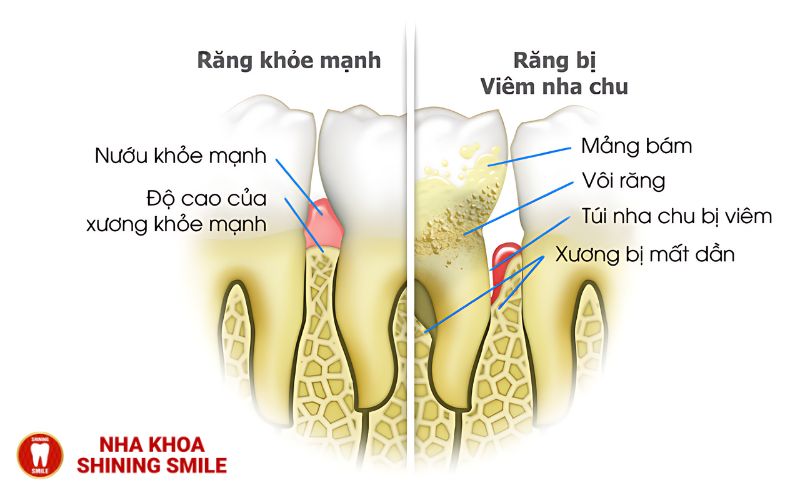 Thời Gian Trồng Răng Implant - Bạn Cần Biết Bao Lâu Để Có Nụ Cười Hoàn Hảo?