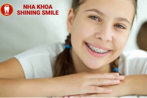 Niềng Răng ở Tuổi 19: Thời Gian Cần Thiết Và Cách Rút Ngắn Quá Trình Điều Trị
