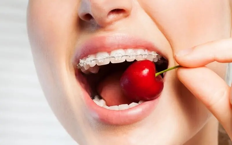 Ưu tiên sử dụng thực phẩm dạng mềm để không làm ảnh hưởng đến chất lượng khí cụ chỉnh nha