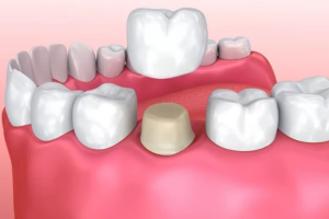 Lựa Chọn Giữa Trồng Răng Sứ và Bọc Răng Sứ: Đâu Là Giải Pháp Tốt Nhất Cho Bạn?