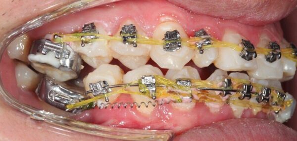 Niềng răng không thành công: Nguyên nhân và cách khắc phục hiệu quả Tìm hiểu những dấu hiệu của niềng răng thất bại