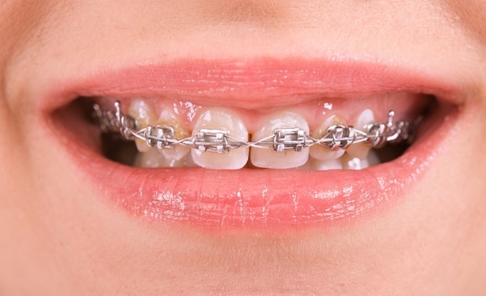 Cách khắc phục tình trạng răng vẩu