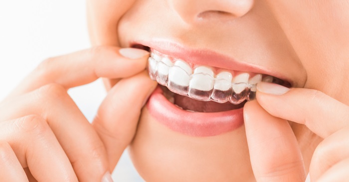 Niềng răng trong suốt Clear Aligner là gì? Hiệu quả điều trị có tốt không? 2 Niềng răng trong suốt Clear Aligner là gì? Hiệu quả điều trị có tốt không? 2