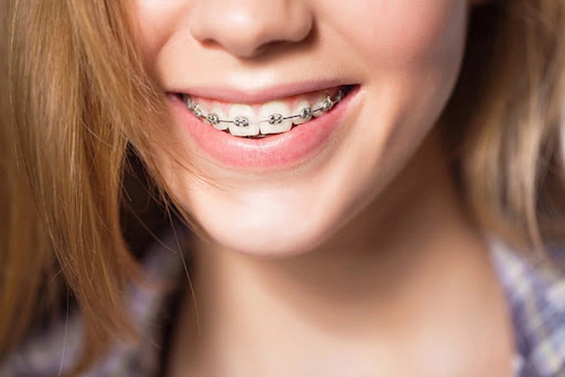 Niềng Răng Là Gì? Niềng Răng Có Quan Hệ Bằng Miệng Được Không? 2
