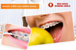 Niềng Răng Có Mewing Được Không? Hiểu Rõ Công Nghệ Tiên Tiến