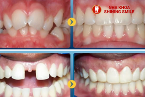 Niềng Răng Kéo Hàm: Giải Pháp Hoàn Hảo Cho Răng Hô, Vẩu