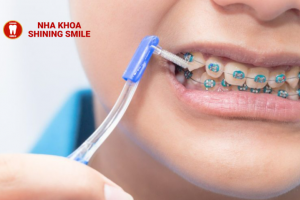 Rủi Ro Khi Niềng Răng Và Cách Phòng Tránh Hiệu Quả