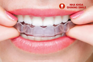 Chụp Phim Niềng Răng: Vai Trò Và Lợi Ích Không Thể Bỏ Qua