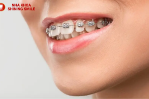 Răng Sứ Kim Loại: Ưu Và Nhược Điểm Bạn Cần Biết