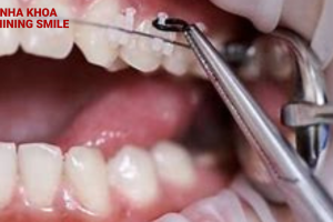 Những điều bạn nên biết về giai đoạn đóng khoảng trong niềng răng