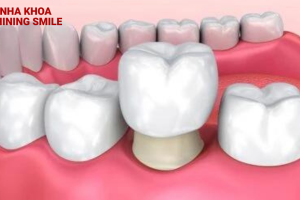 Niềng răng mặt lưỡi: Lựa chọn hoàn hảo