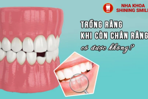 Dịch Vụ Hàn Răng: Quy Trình, Chi Phí Và Lợi Ích