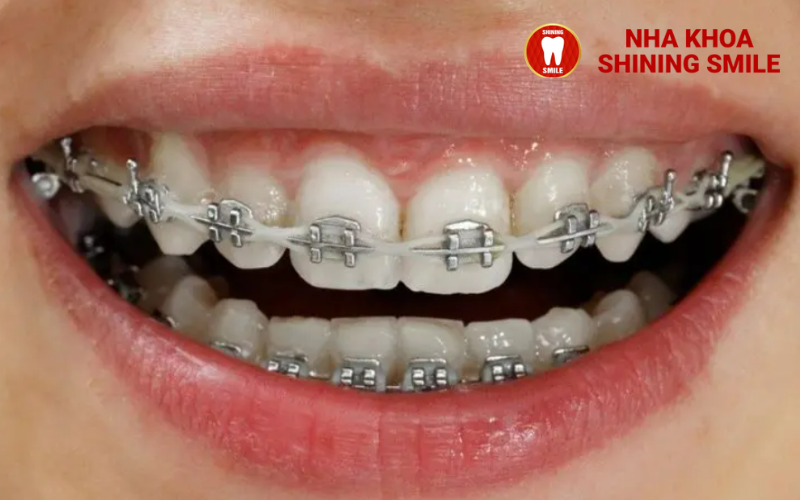 32 Tuổi Có Nên Niềng Răng Không? Câu Trả Lời Từ Chuyên Gia
