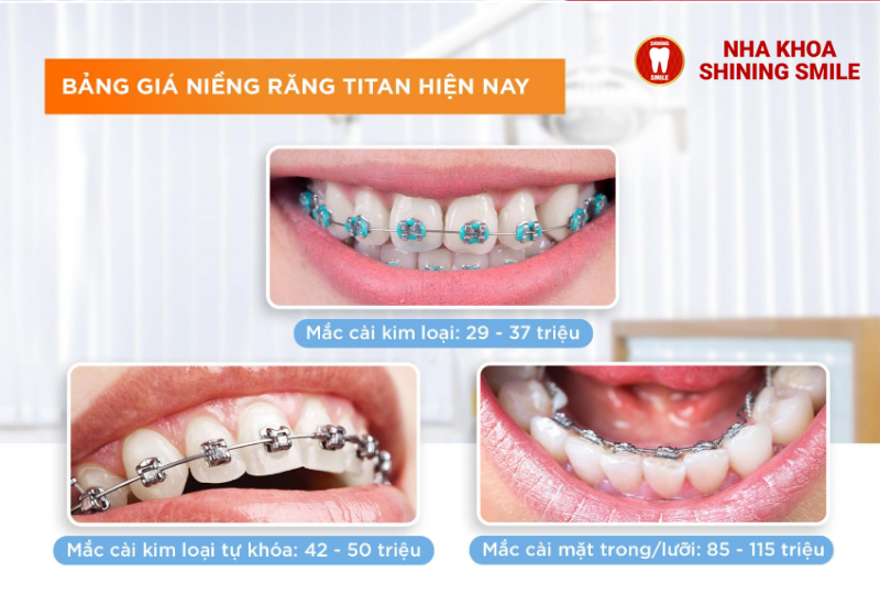 Đặc Điểm Của Mắc Cài Kim Loại 3M Trong Niềng Răng