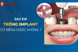 Trồng Răng Có Niềng Được Không? Chuyên Gia Giải Đáp