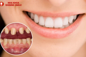 Răng Sứ Zicomax: Công Nghệ Hiện Đại Cho Nụ Cười Rạng Rỡ