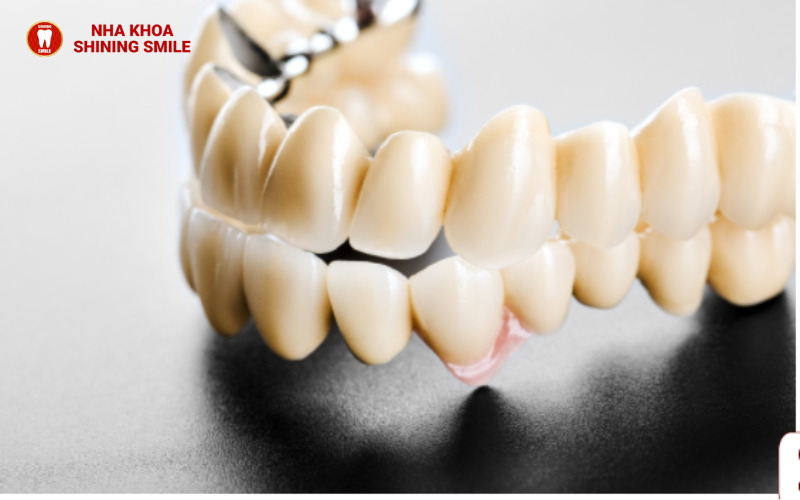 Chi phí trọn gói giá niềng răng cho trẻ 12 tuổi