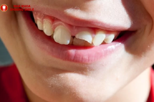 Trồng Răng Rụng Gắn: Phương Pháp Đột Phá Cho Nụ Cười Rạng Rỡ