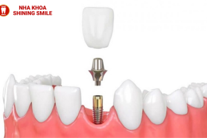 Trồng Răng Trả Góp: Giải Pháp Tài Chính Linh Hoạt Cho Nụ Cười Hoàn Hảo