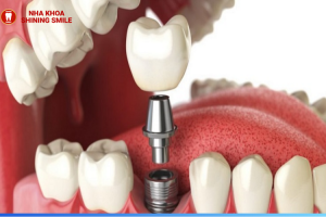 Mất Chân Răng Có Trồng Được Không? Giải Pháp Bất Ngờ Từ Chuyên Gia