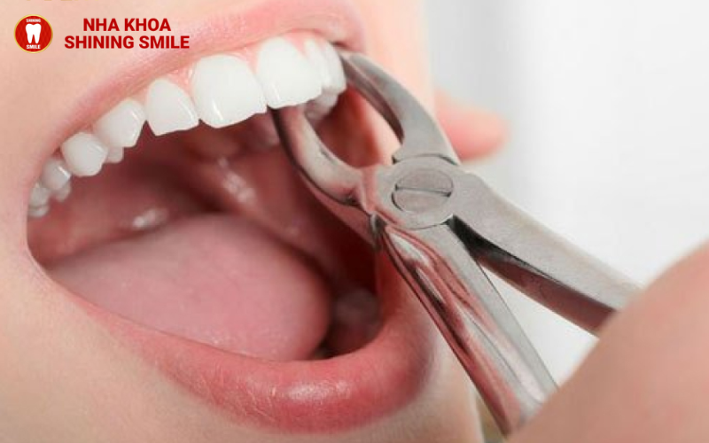 Làm Răng Thỏ Giá Bao Nhiêu? Khám Phá Bảng Giá Và Ưu Đãi Hấp Dẫn
