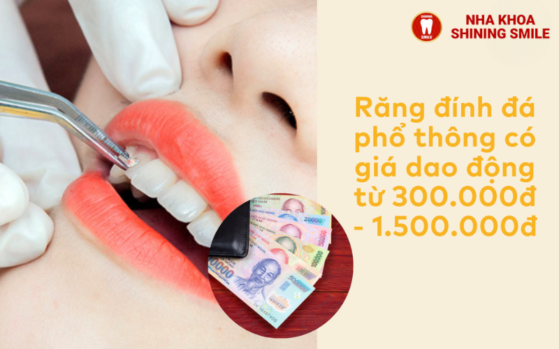 Mắc cài pha lê: Ưu và nhược điểm