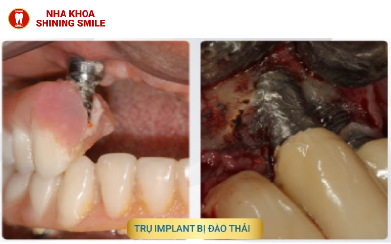 Bảng Màu Răng Sứ: Lựa Chọn Tông Màu Hoàn Hảo Cho Bạn