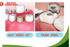 Giá Bọc Răng Hàm Bị Vỡ Là Bao Nhiêu? Đừng Bỏ Lỡ Thông Tin Quan Trọng!