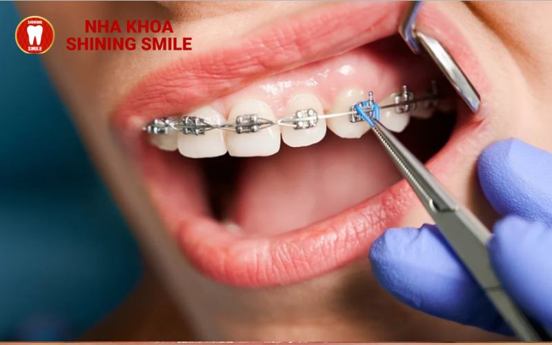 Bọc Răng Sứ Titan: Lựa Chọn Hoàn Hảo Cho Nụ Cười Rạng Rỡ