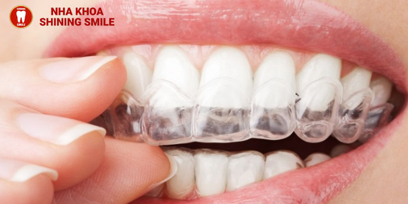 Các Loại Răng Sứ: Đặc Điểm Và Lợi Ích Từng Loại