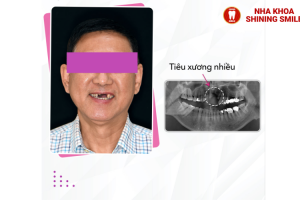 Ghép Xương Răng Bao Nhiêu Tiền? Chi Phí Thực Tế Không Ngờ!