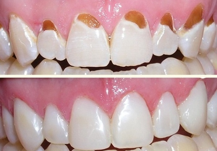 Trám cổ chân răng – Từ A-Z những thông tin bạn cần biết khi thực hiện 2 Trám cổ chân răng – Từ A-Z những thông tin bạn cần biết khi thực hiện 2