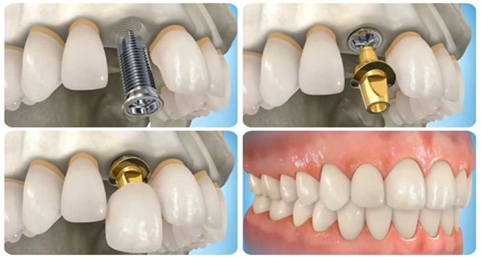 Trồng chân răng bằng phương pháp nào hiệu quả nhất? 1 Trồng chân răng bằng phương pháp nào hiệu quả nhất? 1